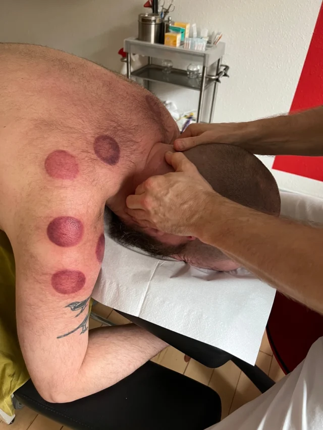 Cupping fremmer blodtilførslen, stimulerer lymfesystemet og hjælper til at afslappe muskler og lindre smerte.  Behandlingen sætter gang i udrensningen af stagnerede affaldsstoffer og ophobet væske. Det er for dig, som har brug for at løsne muskelspændinger, lindre og afhjælpe spændingshovedpine og migræne, mindske væskeophobninger og hævelser samt støtte dit immunforsvar og fordøjelse.  Er du nysgerrig på om det kan være noget for dig, så vid at du altid er velkommen til at kontakte mig på tlf: 2216 6691 eller mail: jb@aku-jon.dk 📲​​​​​​​​
.
.
.
.
#massage #cupping #stress #angst #senfølger #aarhus #behandling #smerter #akupunktur #acupuncture #alternativmedicin #sundhed #akupressur #energiarbejde #behandleraarhus #østligmedicin #TCM #firecupping